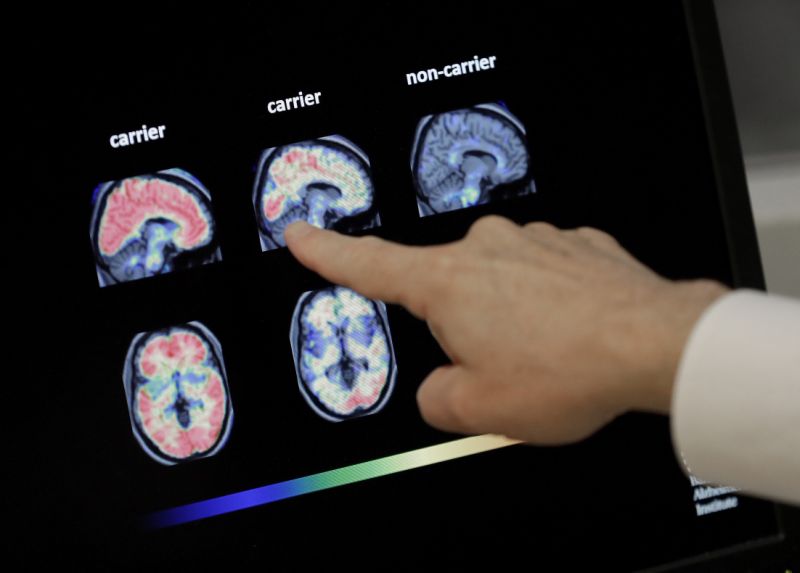 FILE - In this Aug. 14, 2018 file photo, Dr. William Burke goes over a PET brain scan at Banner Alzheimers Institute in Phoenix. The drug company Biogen Inc. says it will seek federal approval for a medicine to treat early Alzheimer's disease, a landmark step toward finding a treatment that can alter the course of the most common form of dementia. The announcement Tuesday, Oct. 22, 2019, is a surprise because the company earlier this year stopped two studies of the drug, called aducanumab, after partial results suggested it was not working. (AP Photo/Matt York, File)