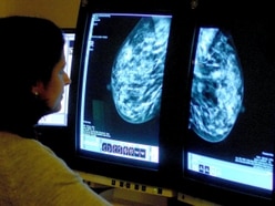 UK could experience up to 35,000 excess cancer-related deaths due to Covid-19